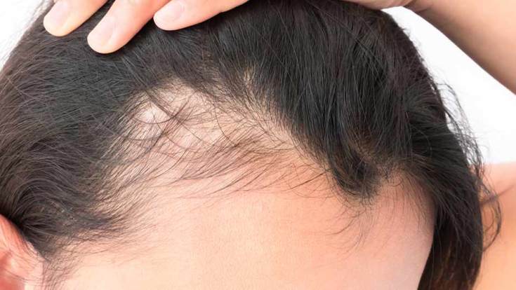 Causes of hair loss in women after 40