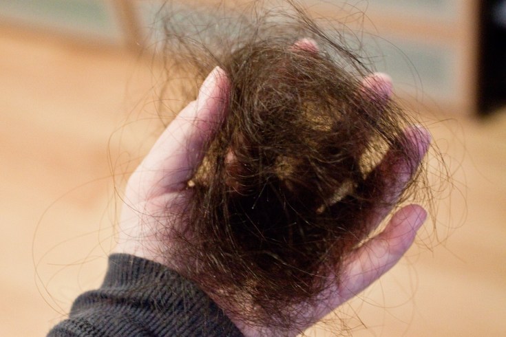 Causes of hair loss in women after 40