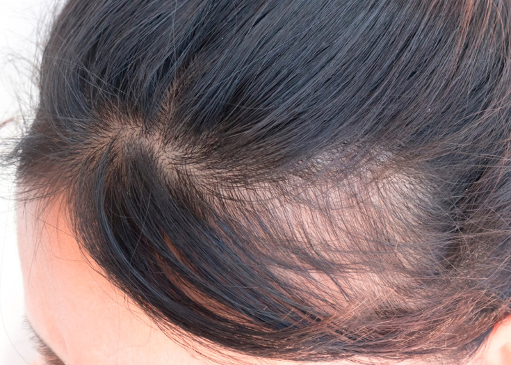 Causes of hair loss in women after 40