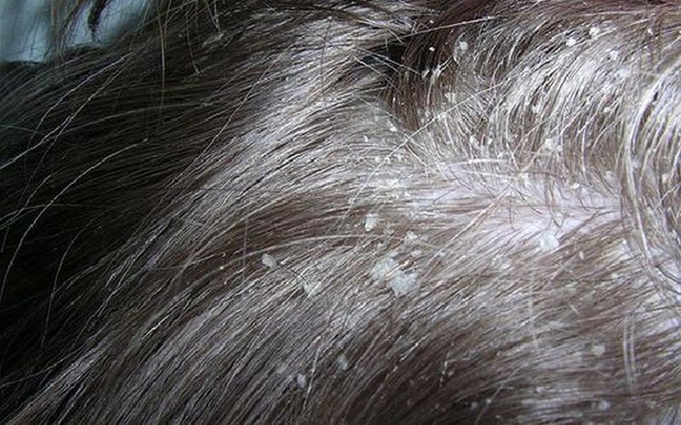 Homemade dandruff masks for hair