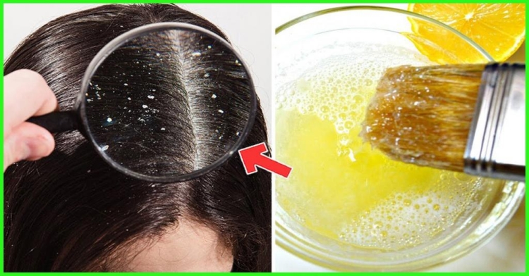 Homemade dandruff masks for hair