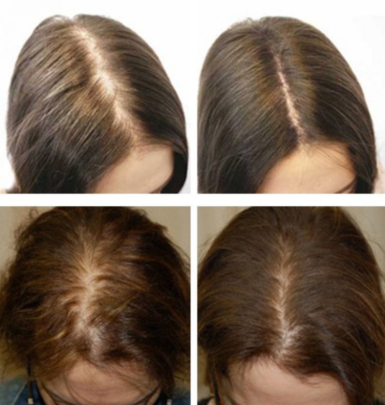 Folk remedies for hair loss in women at home