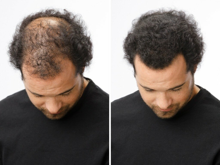 Jack's hair restoration