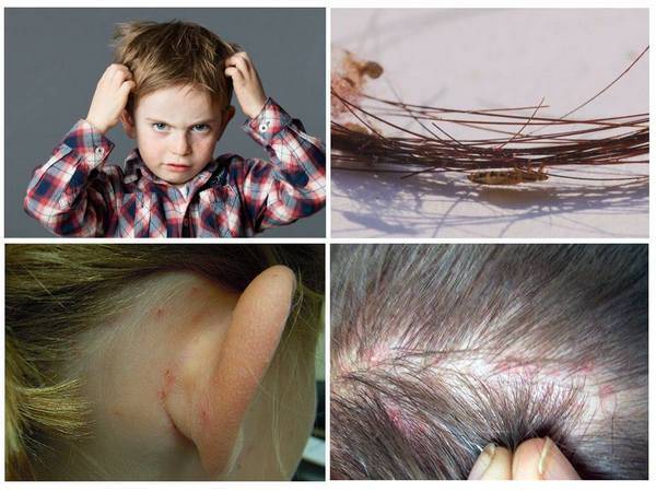 How to quickly get rid of nits and lice at home