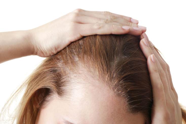 Hair loss from stress