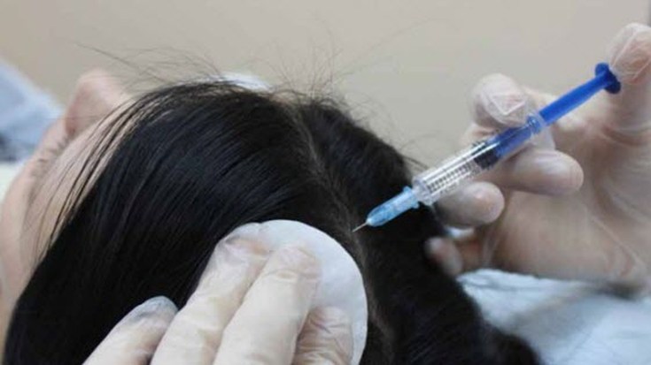 Ozone therapy for the scalp