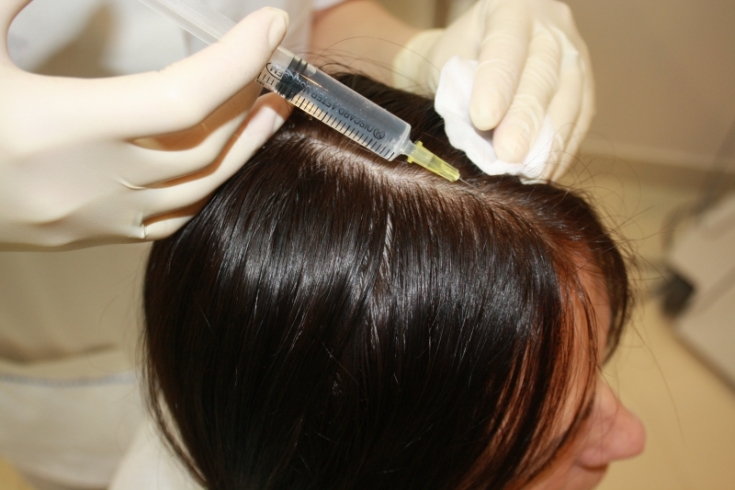 Ozone therapy for the scalp