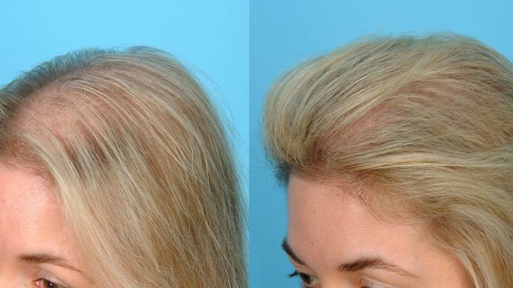 Ozone therapy for the scalp