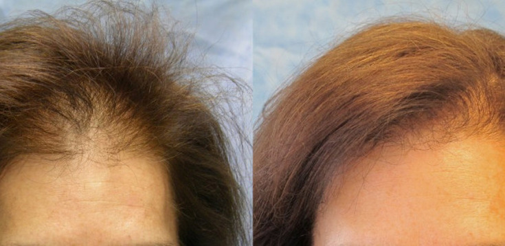 Ozone therapy for the scalp