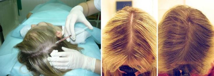 Ozone therapy for the scalp