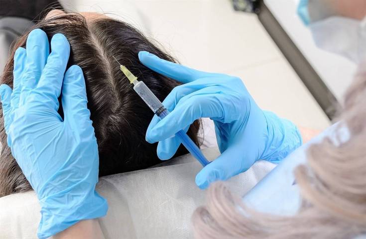 Ozone therapy for the scalp