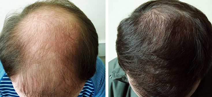 Plasmolifting for hair loss