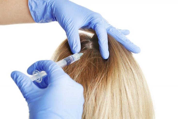 Plasmolifting for hair loss