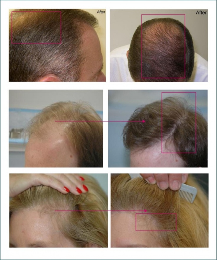 Plasmolifting for hair loss