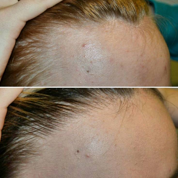 Plasmolifting for hair loss