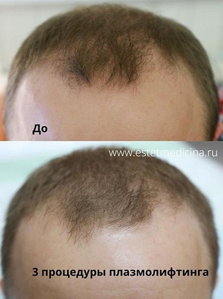 Plasmolifting for hair loss