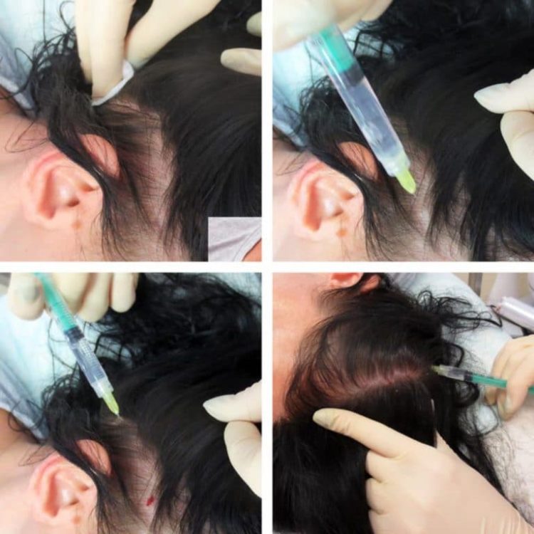 All about hair mesotherapy